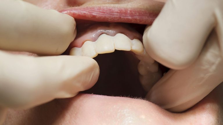 French Dentists Warn Over Chinese Dentures