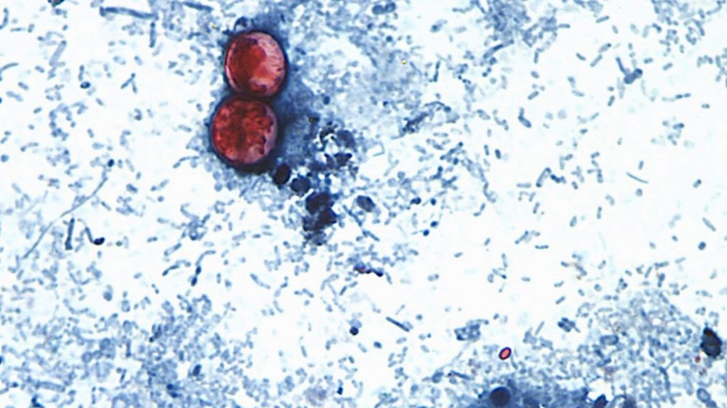 US Cyclospora Outbreak: FDA Finds Source in Mexican Lettuce